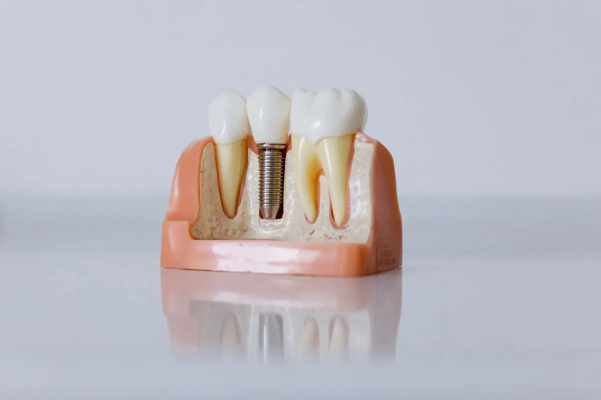 Implantes dentales en adultos mayores: la edad no es lo que decide
